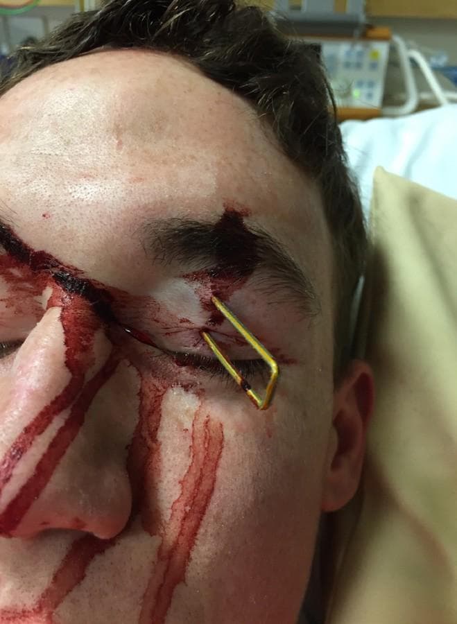 Posterior Eye Trauma Diagnosis Prevents Blindness