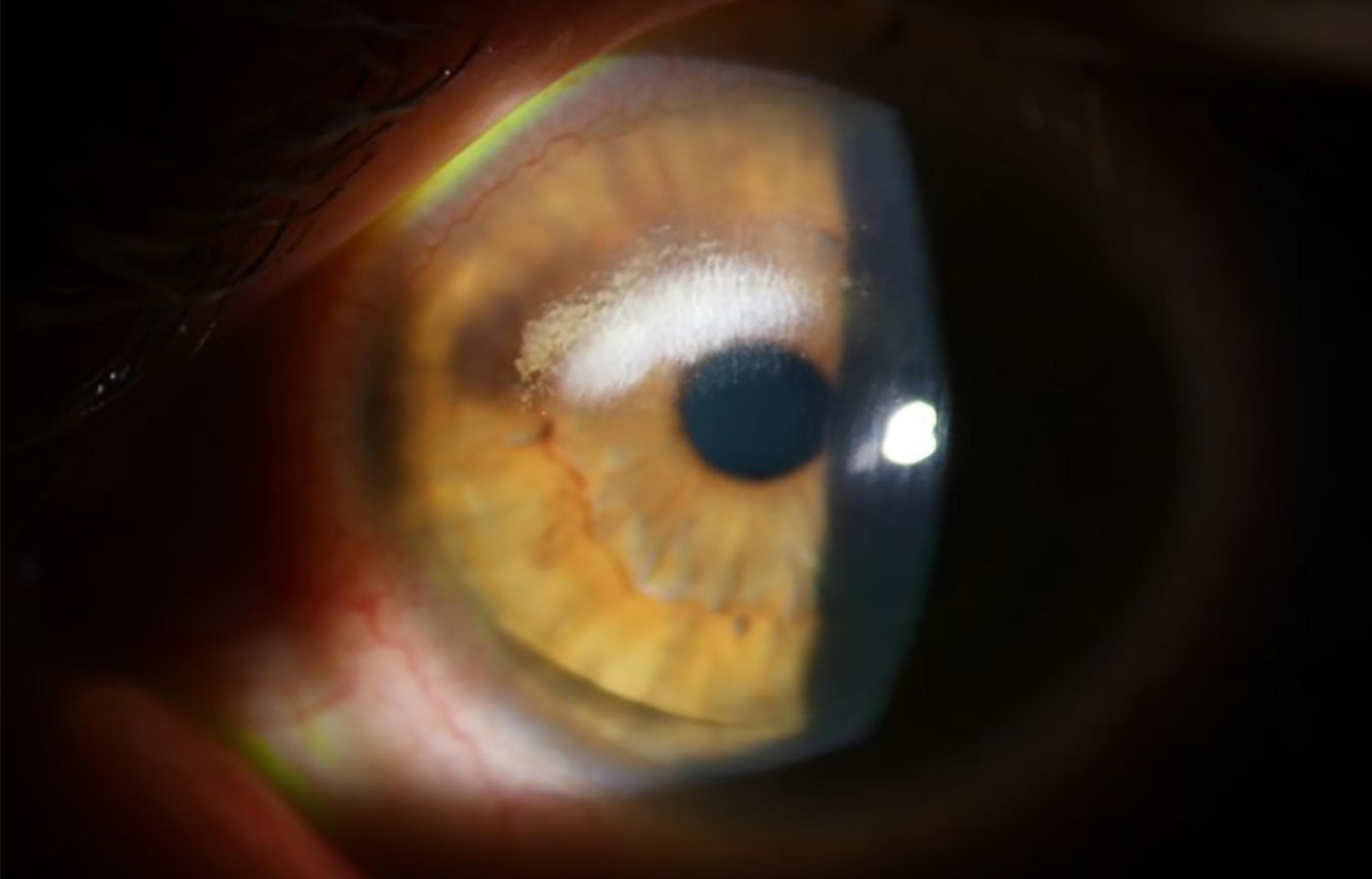 Causes & Management Lipid Keratopathy in Scleral Lens Wearers