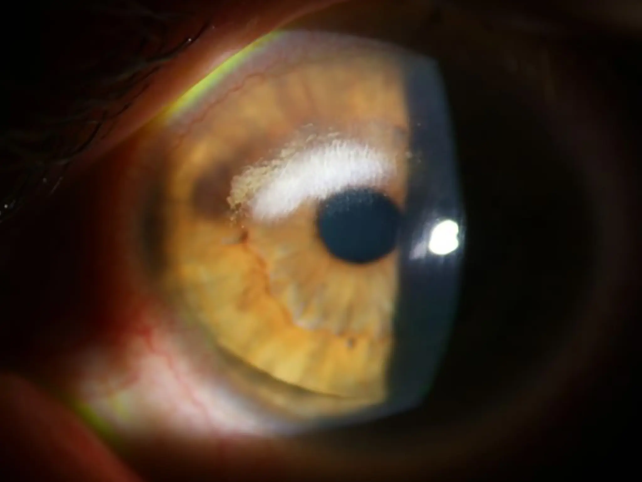 Causes & Management Lipid Keratopathy in Scleral Lens Wearers