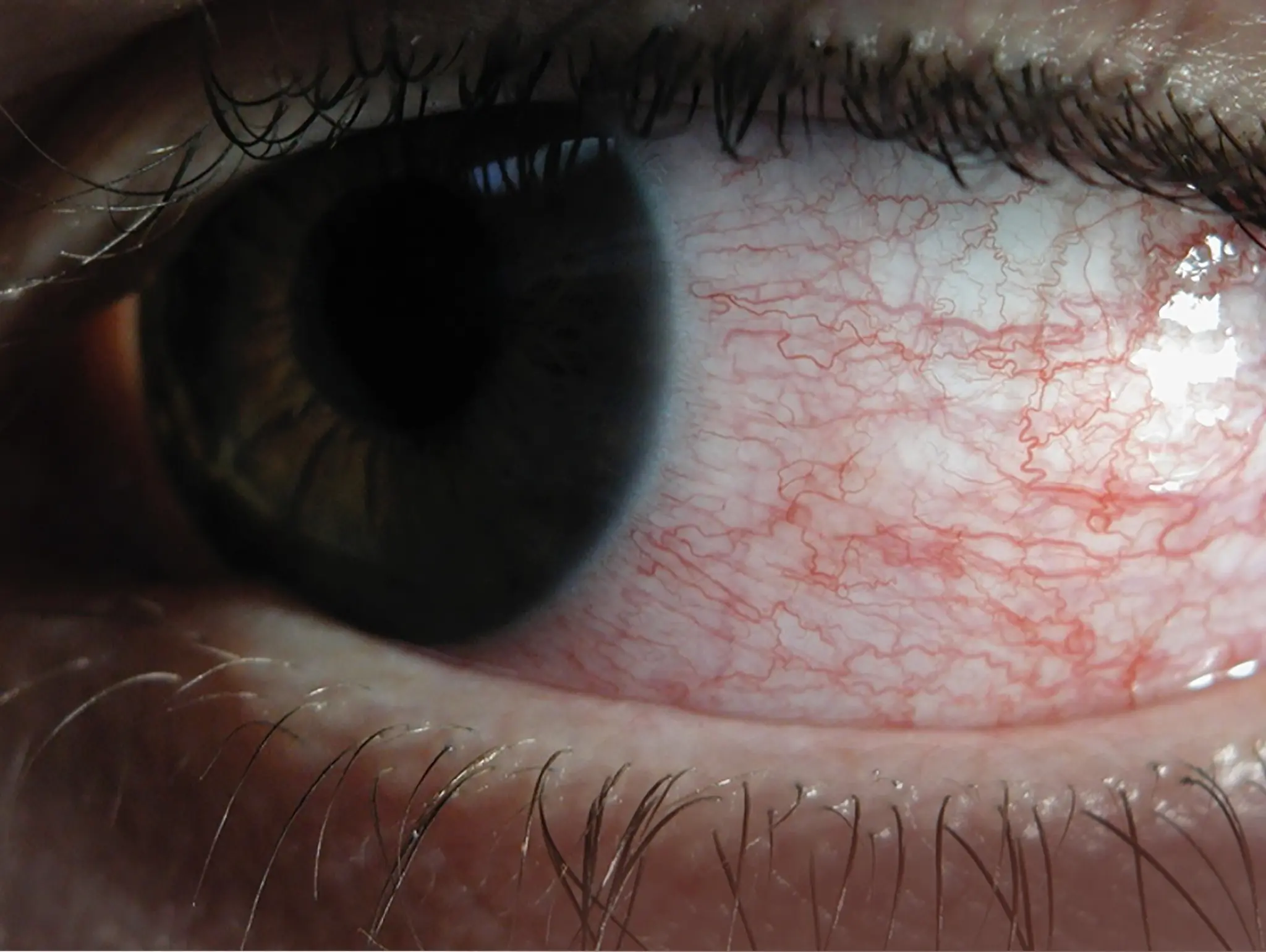 Dry Eye and Allergies Impact on Interaction