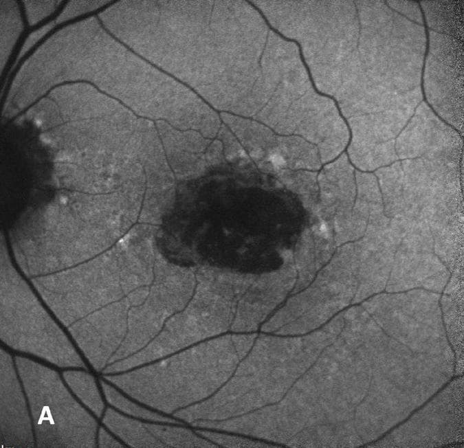 A New Era in AMD Management: Treatments for Geographic Atrophy