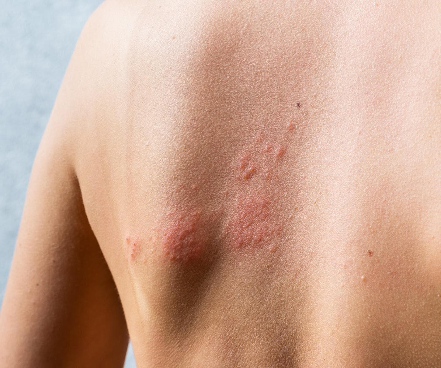 Promising results announced from GSK’s shingles trial in China