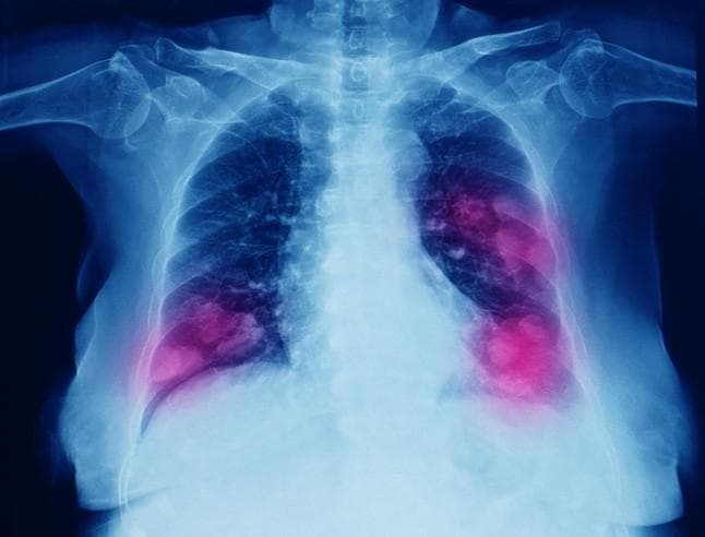 AstraZeneca & Daiichi Sankyo announce results from DESTINY-Lung02 trial of Enhertu for NSCLC 
