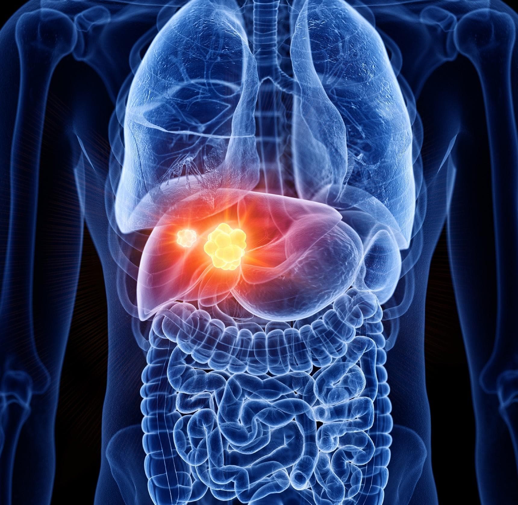 AstraZeneca’s Imfinzi meets primary endpoint for liver cancer treatment