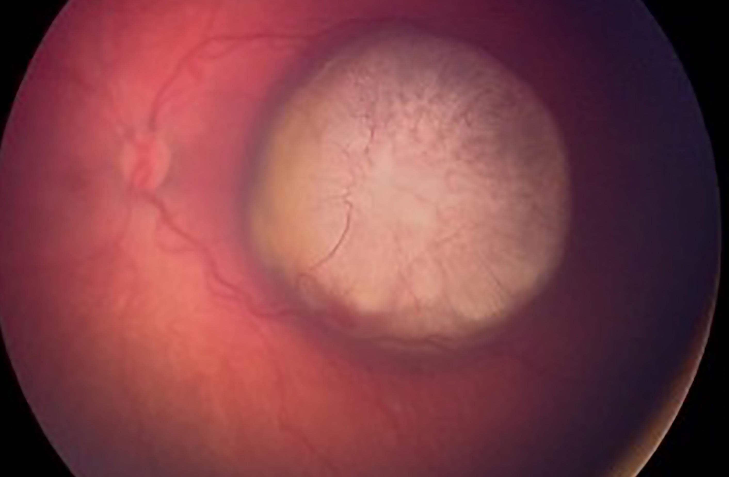 Leukocoria and Strabismus